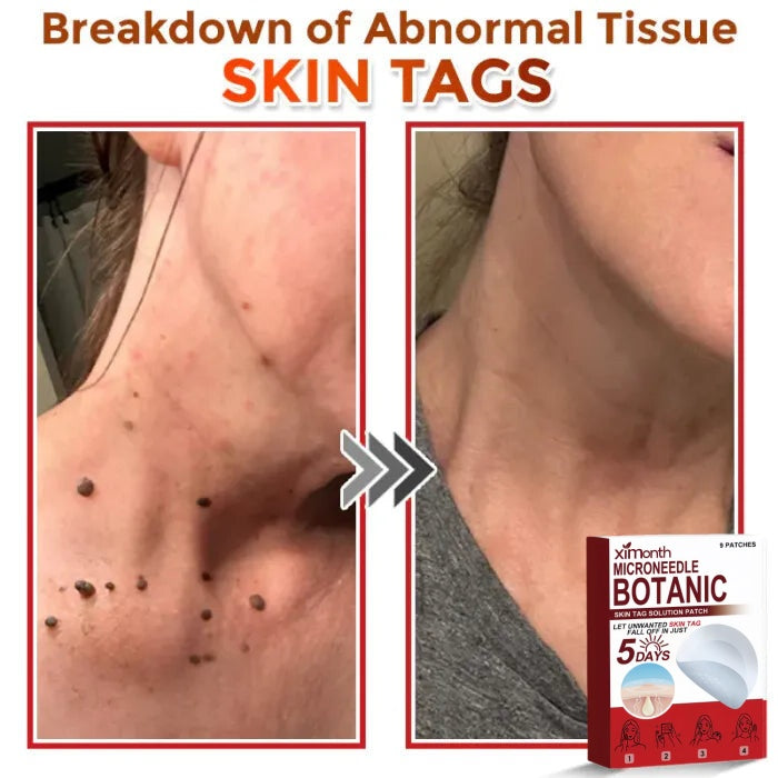 Ximonth Removal Patch