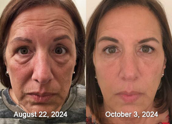 🎅CHRISTMAS HOT SALE-🏆Ends Today: 60% OFF! KLENIMORE™ (Made and Shipped from USA) 🧑⚕️Botox Bee Venom Wrinkle Removal Cream