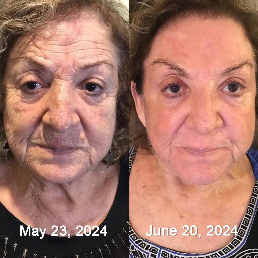 🎅CHRISTMAS HOT SALE-🏆Ends Today: 60% OFF! KLENIMORE™ (Made and Shipped from USA) 🧑‍⚕️Botox Bee Venom Wrinkle Removal Cream