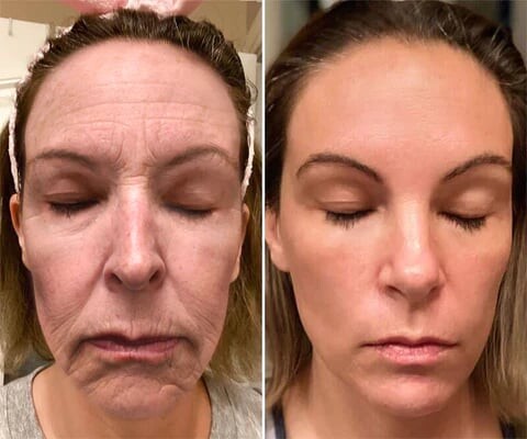 🎅CHRISTMAS HOT SALE-🏆Ends Today: 60% OFF! KLENIMORE™ (Made and Shipped from USA) 🧑‍⚕️Botox Bee Venom Wrinkle Removal Cream